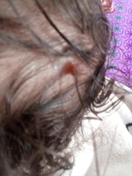 Ako riešiť vyrážky na hlave u detí?