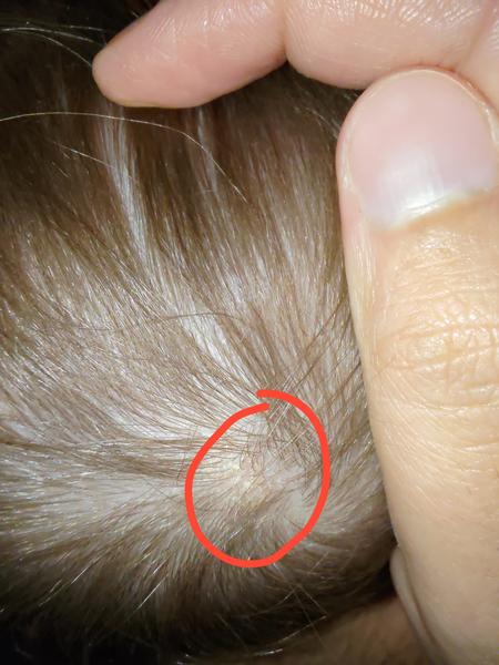 Čo je suché a šupinaté na hlave dieťaťa?