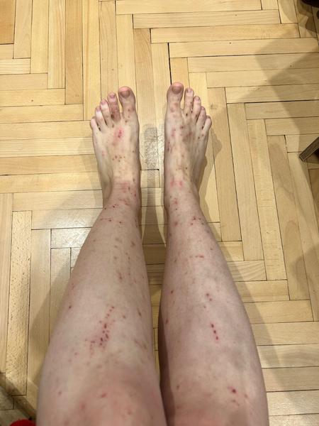 Atopický ekzém trvajúci niekoľko mesiacov