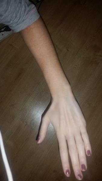 19 ročné dievča je slabé, chrbát a ruky má bledšie