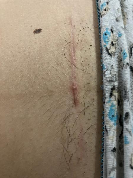 Je táto jazva po sekcii v poriadku?