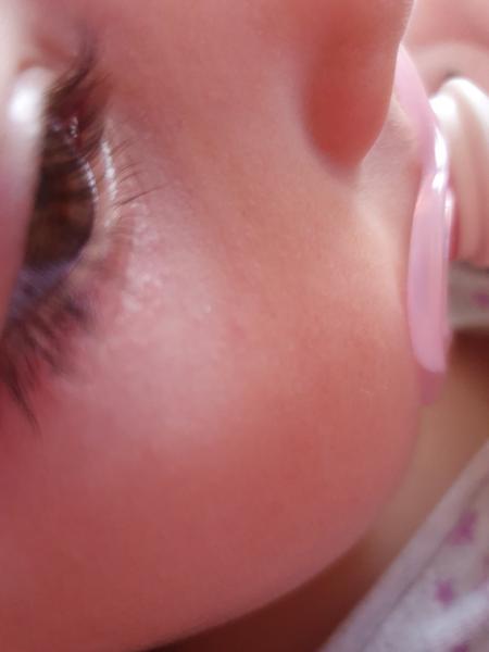 Aké vyrážky to má dcérka pod jedným okom?