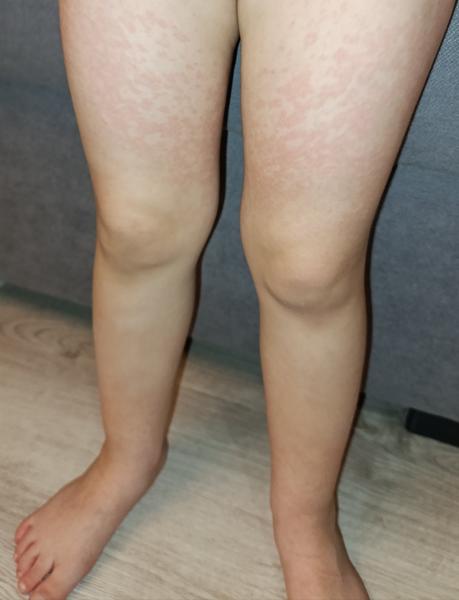 Prečo má moja dcéra vyrážky na nohách?