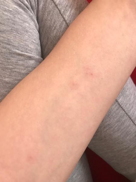 Svrbiace vyrážky vyzerajúce ako štípance.