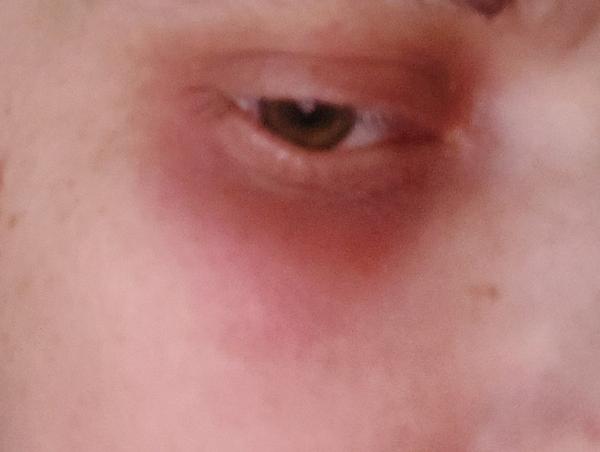 Prebudila som sa so zapáleným okom