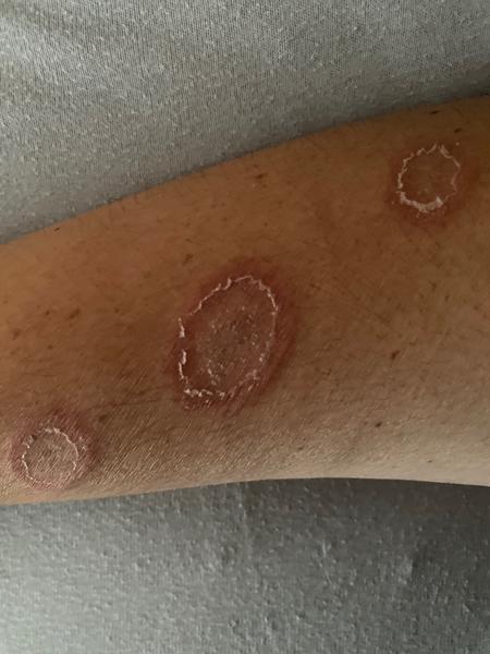 Ako liečiť mykózu zo zvierat?