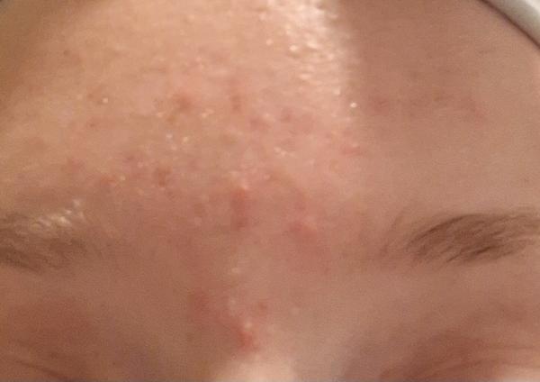 Najlepšie produkty pre citlivú pleť s upchatými pórmi