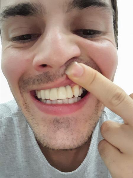 Sú vaše zubné korunky a implantáty v poriadku?