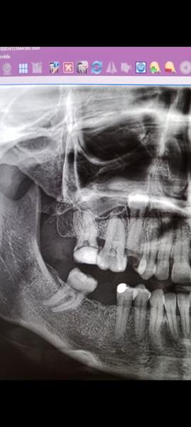 Bolí operatívne vytrhnutie zlého zubu? Skúsenosti a rady