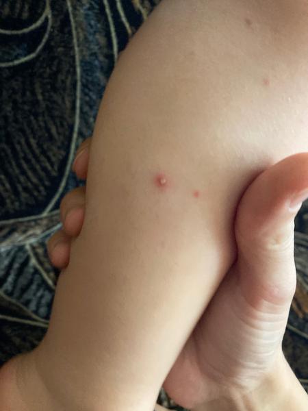 Sú to kiahne alebo 6-ta choroba?