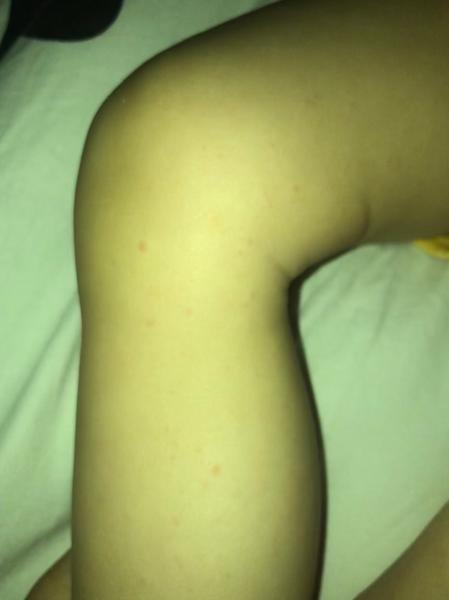 Má dieťa kiahne alebo reakciu na antibiotiká?