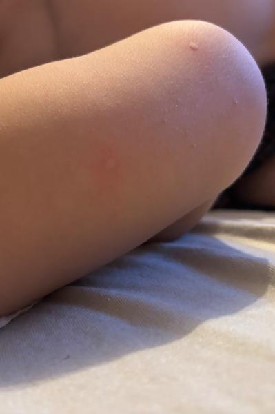 Príčiny vyrážok u ročného dieťaťa