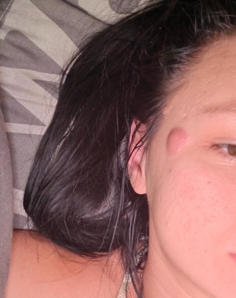 Je toto podľa vás podkožná vyrážka?