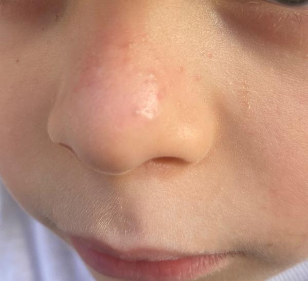 Ako riešiť letné vyrážky na nose u detí?