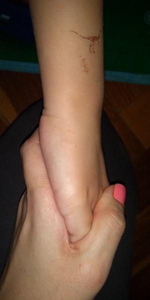 Vyrážky 4-ročného týždeň po chorobe, čo to môže byť?