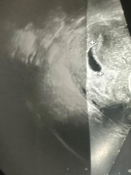 Prázdny vak v 7. týždni tehotenstva: Aké sú vaše skúsenosti?