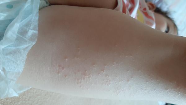 Ide o alergickú reakciu?