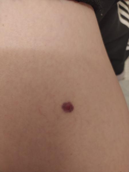 Aké znamienko to mám na stehne?