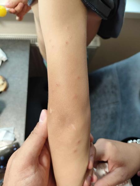 Od čoho vznikajú neznáme vyrážky?