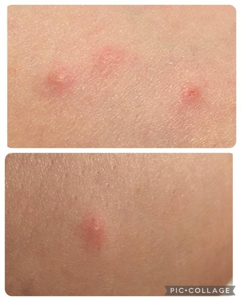 Spoznávate takéto štípance od hmyzu?