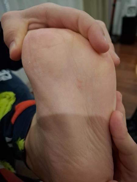 Pupáčiky na chodidlách detí