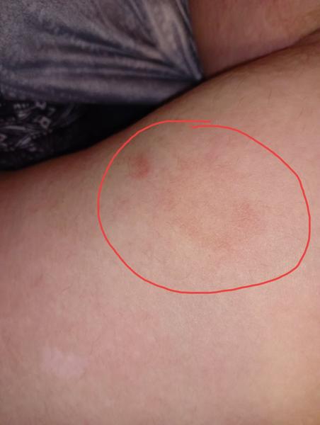 Čo spôsobuje fľaky na stehne?