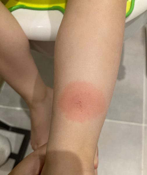 Od čoho je tento štípanec?