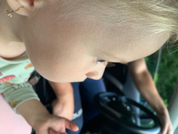 Aké vyrážky má moja dvojročná dcérka?