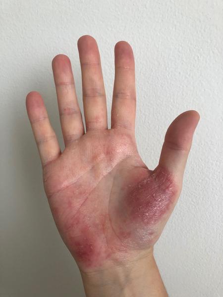 Zúfalstvo z ekzému