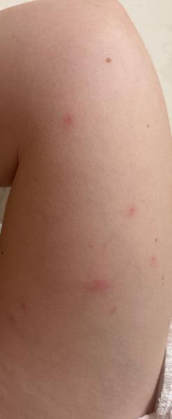 Ako rozpoznať štípanec od ploštice?