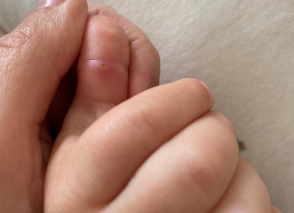 Čo to má moje dieťa na prste?