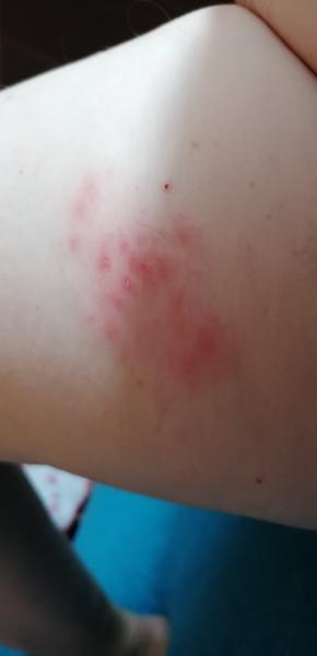 Čo môže spôsobiť neznáme štípance?