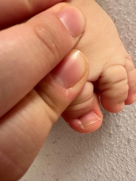 Opuch na prste u ročného dieťaťa