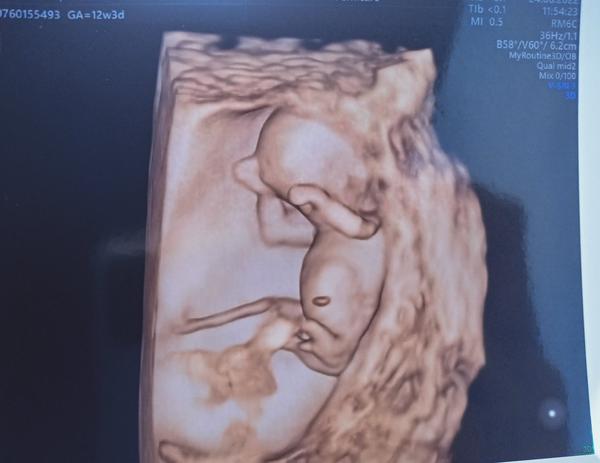 Aké je pohlavie dieťatka podľa tejto fotky?