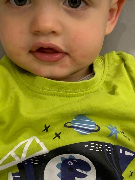 Môže mať 1,5-ročný syn intoleranciu i napriek tomu, že má výsledky v poriadku?