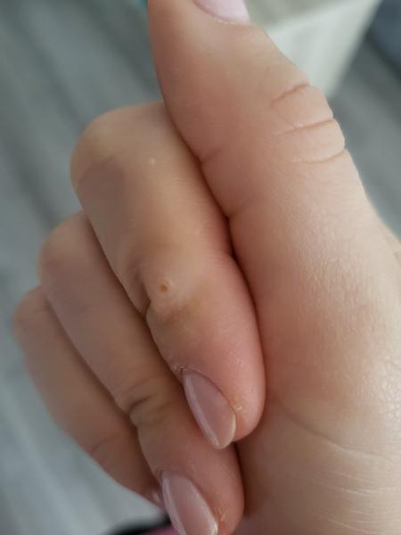 Čo môže byť výrastok na prste?