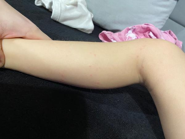 Je svrbenie a vyrážky u detí alergia či svrab?