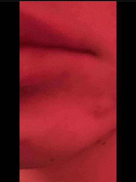 Vystúpená hrča na tvári - čo s ňou?