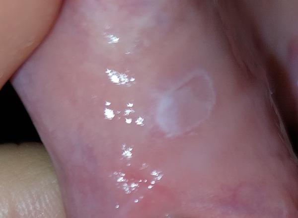 Aký fľak má moja dcéra v ústach?