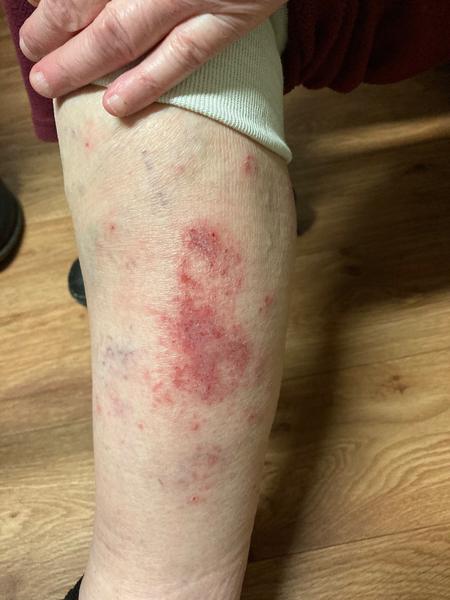 Čo to má moja 79 ročná mamka na nohe?