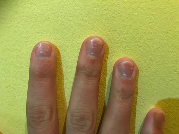 Aké vitamíny mi chýbajú, keď mám biele škvrny na nechtoch?