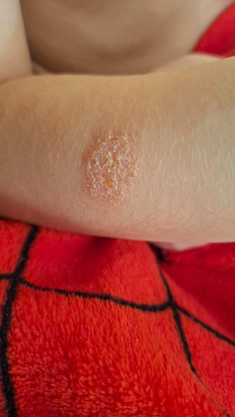 Je impetigo zodpovedné za synove príznaky?