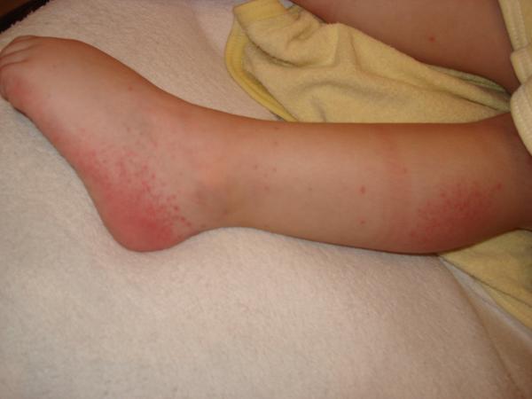 Výsyp na telíčku. Sú to kiahne?