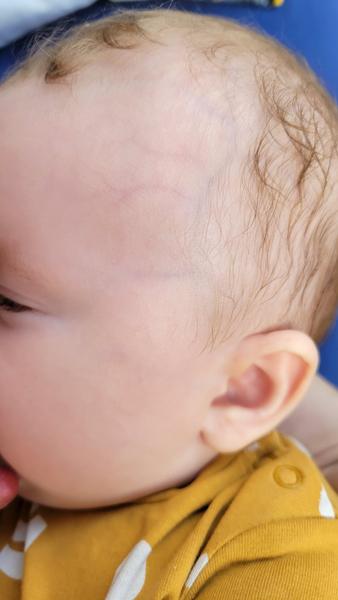 Sú v poriadku viditeľné žilky na spánkoch a nose u bábätka?