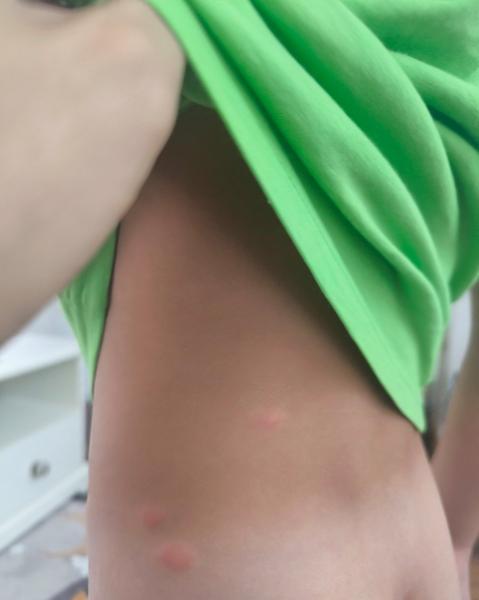 Z čoho sú svrbiace štípance u detí?