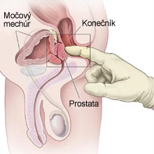 Vyšetrenie prostaty