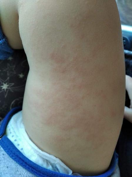 Aké vyrážky to má 20 mesačná dcéra na nohe a na ruke?