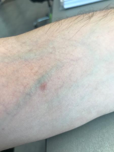 Bodka po kliešťovi