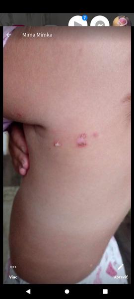 Môžu to byť kiahne?