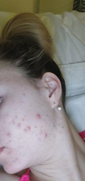 Isotretinoin na akné: Potrebujem lieky?